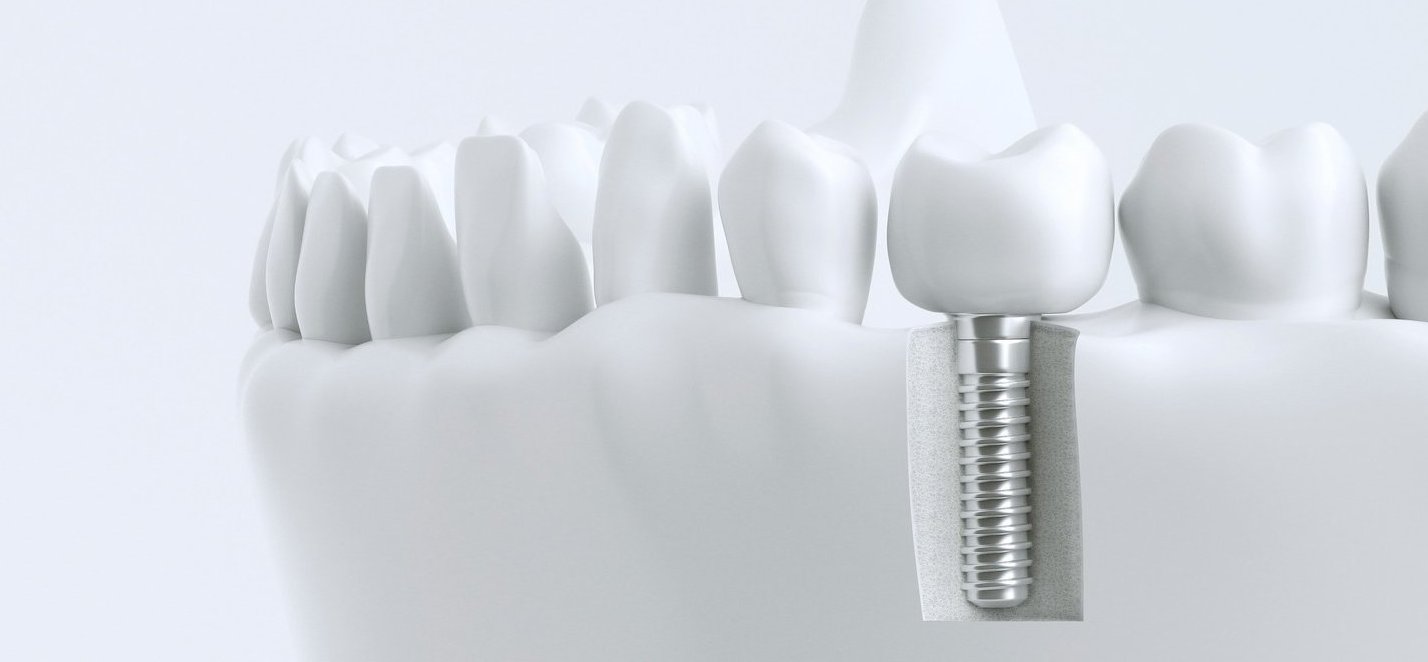 インプラント イメージ